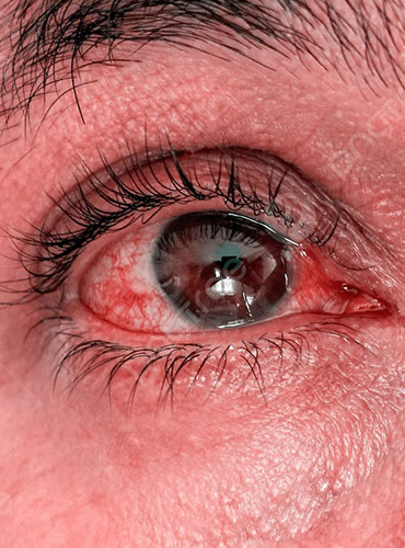 Enfermedades de los Ojos